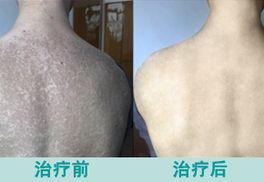 山东烟台市皮肤病治疗最好医院