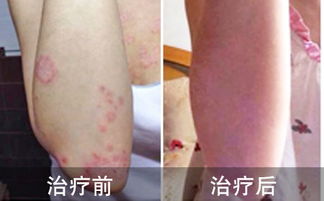 治好牛皮癣,丢掉尴尬