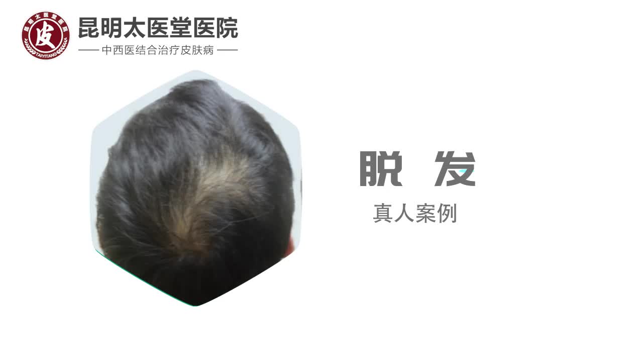 昆明太医堂皮肤病研究院:治好脱发,自信生活