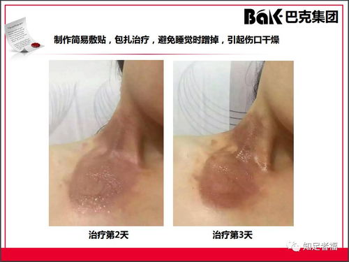 一切皮肤病及外伤的克星,传统文化义工的事业 巴克产品介绍