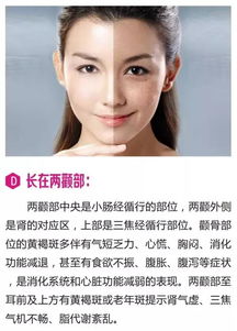 铂钰祛斑 黄褐斑是写在女人脸上的 病