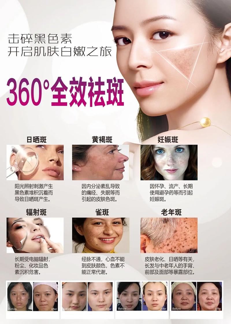 祛斑海报.#美白淡斑 #美容院 #祛斑 #皮肤管理中心 #