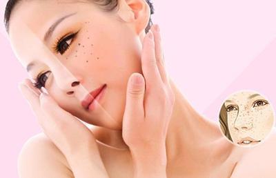 4大祛斑误区,你中招了吗?