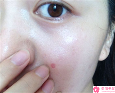 做激光祛斑美容哪儿做得效果好