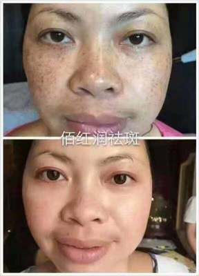 佰红润一次性祛斑专家