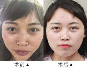 祛斑后出现返黑 烫伤 永久性疤痕等后遗症 都是因为你用错了它