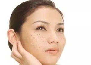 如何快速祛斑,怎么祛斑效果好 宣博士