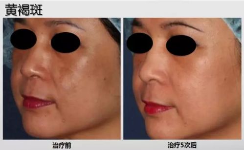 春语祛斑神器 蜂巢皮秒为何如此火爆