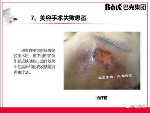 一切皮肤病及外伤的克星,传统文化义工的事业 巴克产品介绍